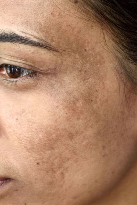 Discover the Root Cause of Melasma and How to Treat It
