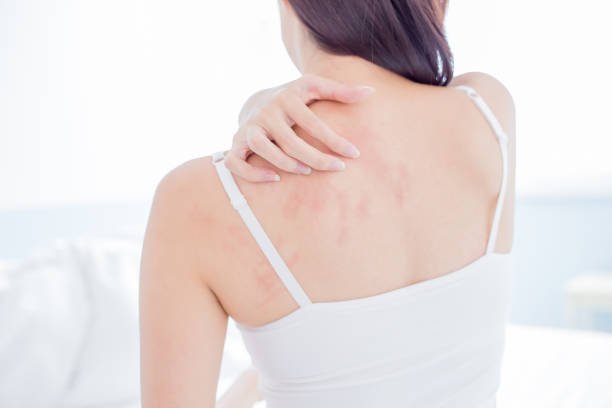 How to Manage Eczema from the Inside Out