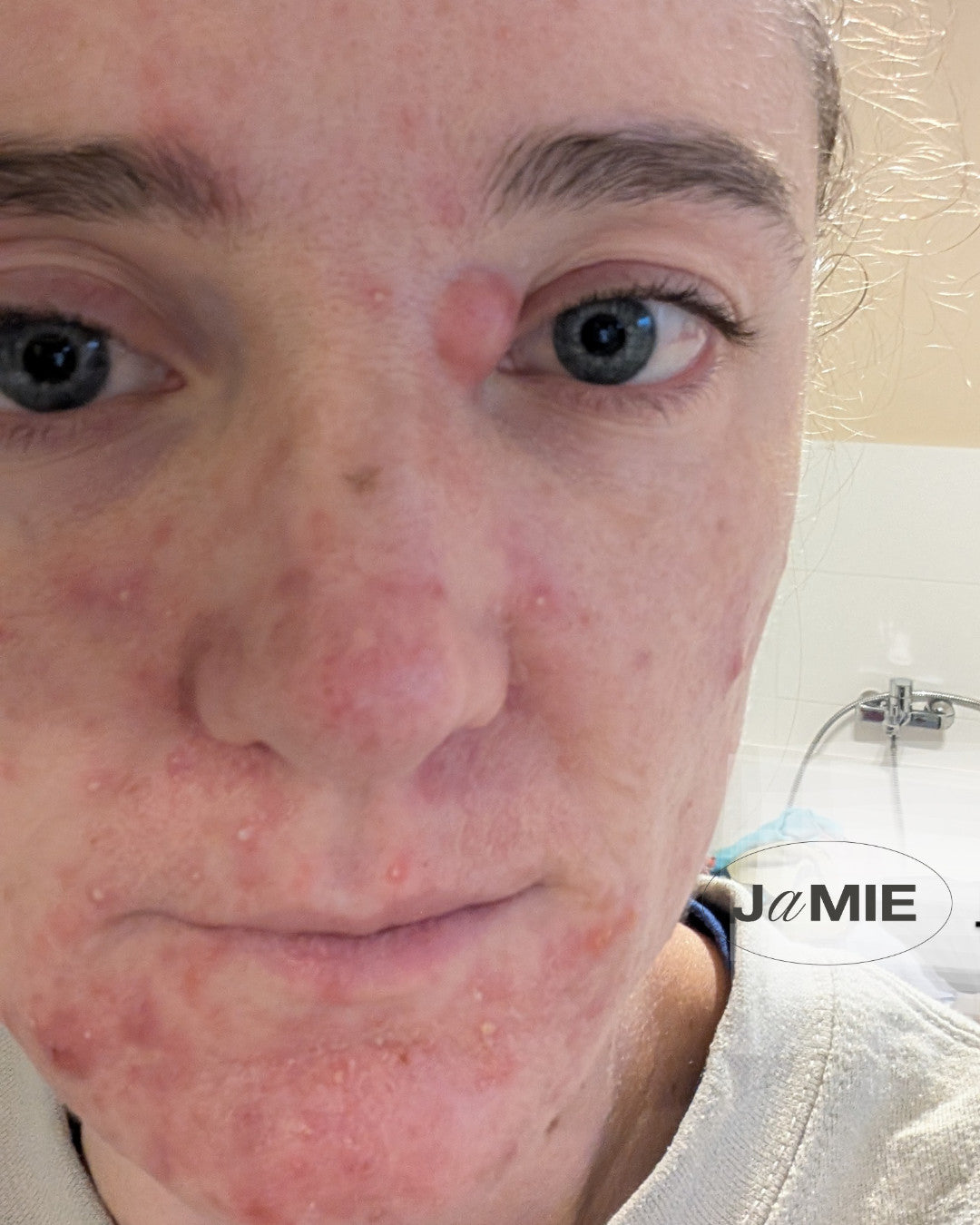 Client's face with visible acne before consultation